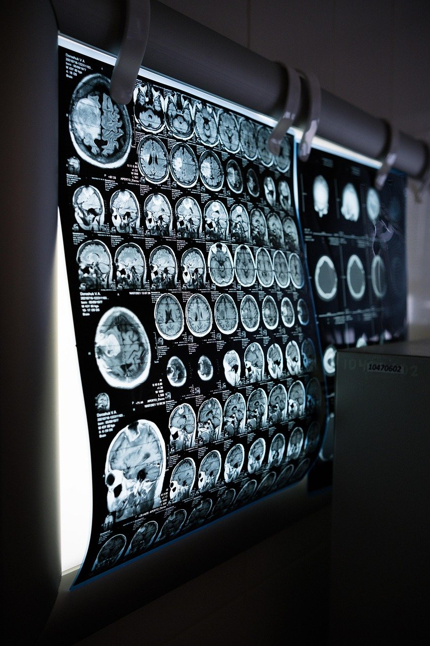 ct scan, mri, cat scan, head, brain, magnetic resonance imaging, hospital, medical procedure, medical results, medical reading, medicine, health, ct scan, ct scan, mri, mri, mri, mri, mri